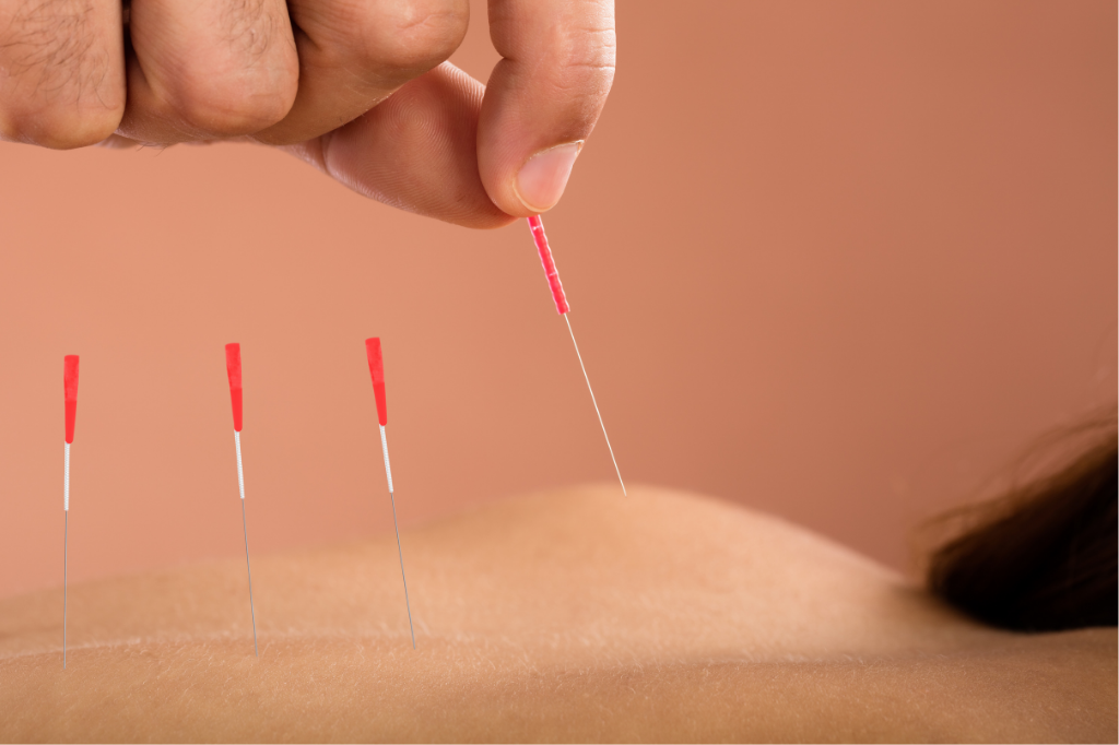 Acupuncture During Pregnancy: Safety, Benefits, and Risks